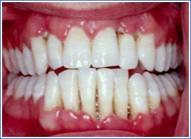 Periodontal disease