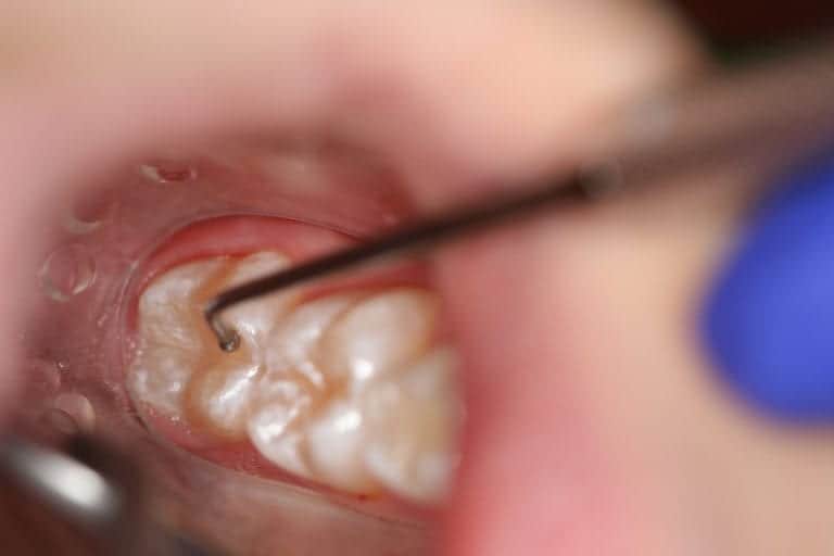 Caries Prevention Sealants Smiles for Life Oral Health