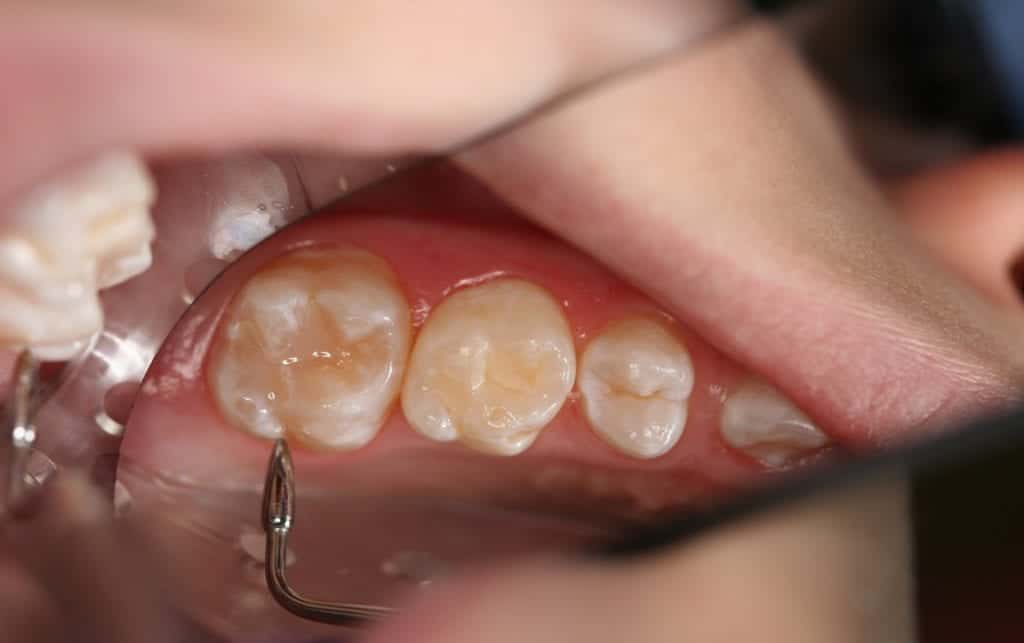 Caries Prevention Sealants Smiles for Life Oral Health