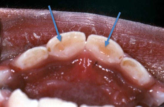 toothabnormalities