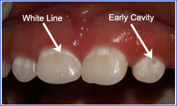 m2_whitespots1