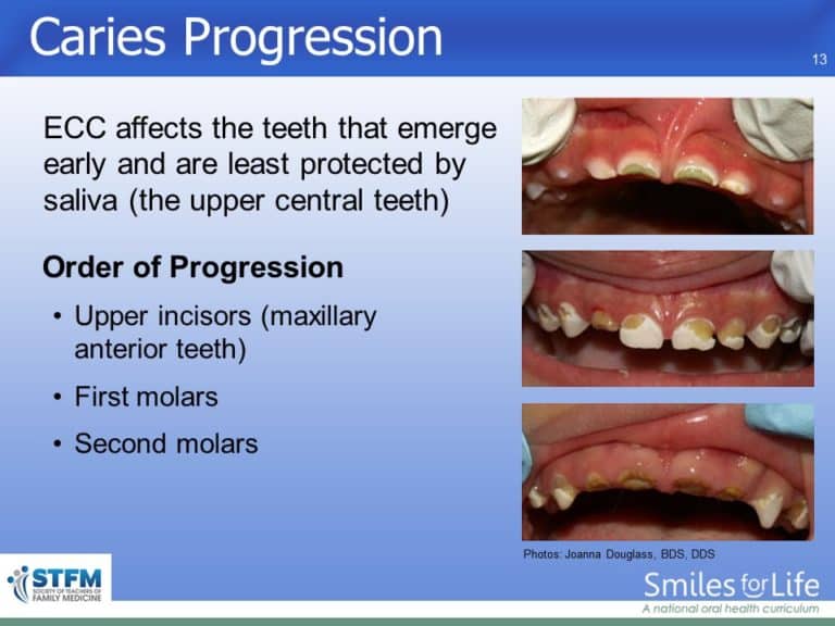 Module 6 Slide 13 Smiles for Life Oral Health