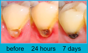 Progression of SDF staining Illustration showing the progression of staining with SDF use