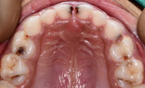 Dental caries