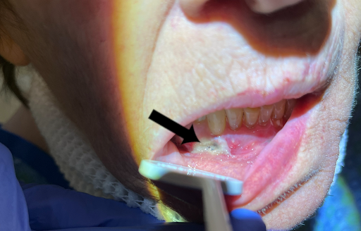 Photo with permission, S. Stille DMD,
Dental abscess with draining fistula